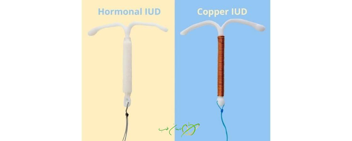 انواع آی یو دی (IUD) و نحوه عملکرد هر یک چگونه است ؟