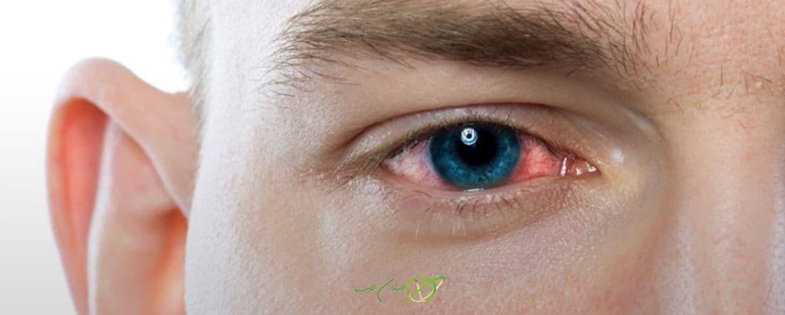 التهاب و عفونت های چشم